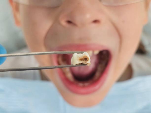 Best Emergency Root Canal Treatment in Richmond, IL